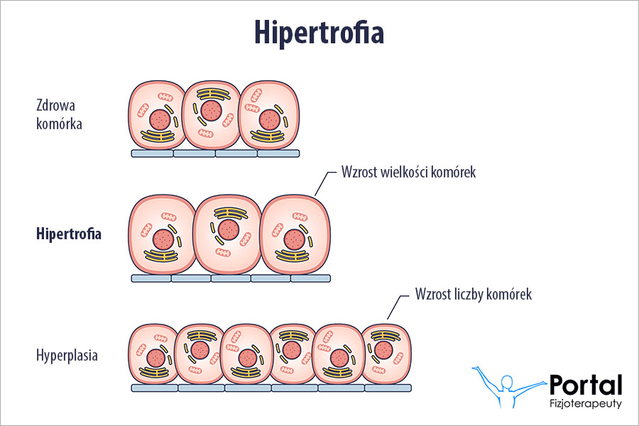 Hipertrofia