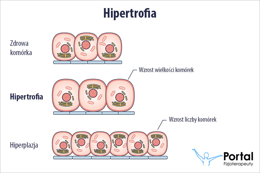 Hipertrofia