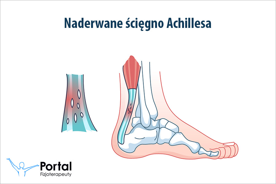 Naderwane ścięgno Achillesa