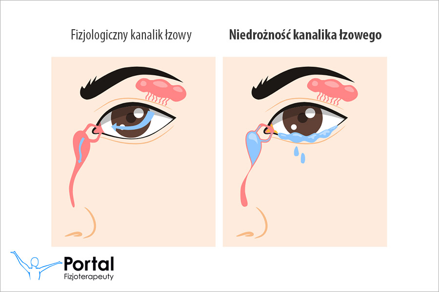 Niedrożność kanalika łzowego