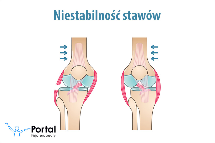Niestabilność stawów