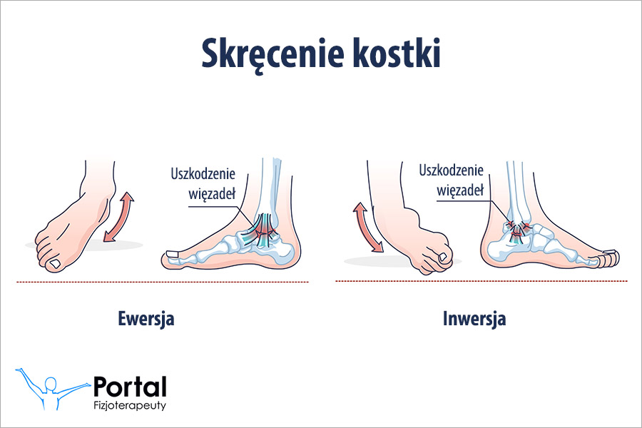 Skręcenie kostki