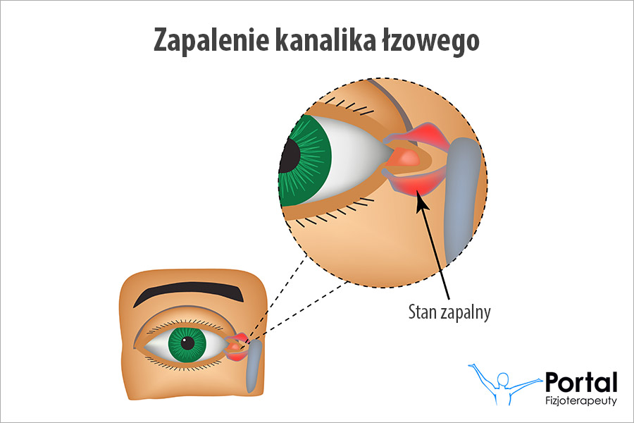 Zapalenie kanalika łzowego