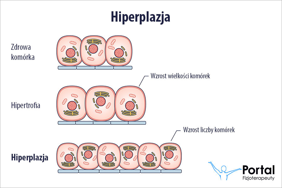 Hiperplazja
