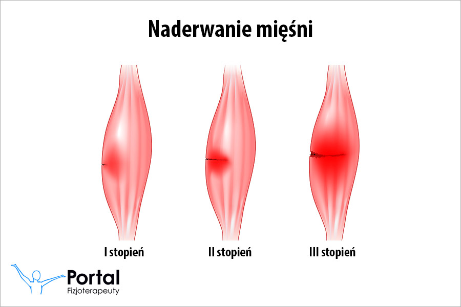 Naderwanie mięśni