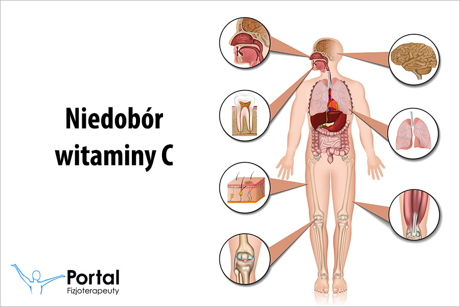 Niedobór witaminy C