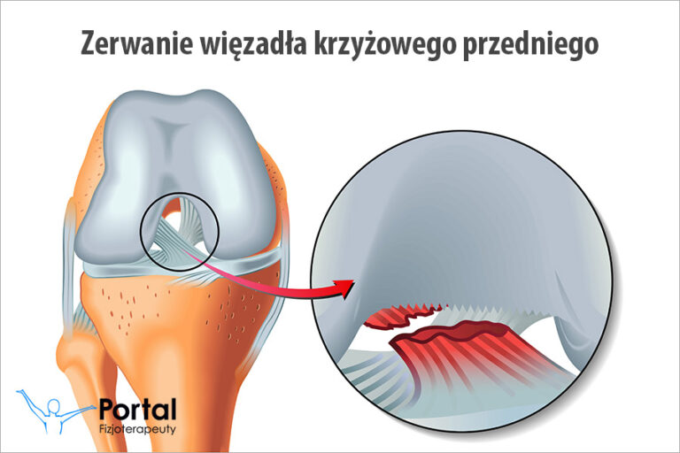 Zerwanie więzadła krzyżowego przedniego
