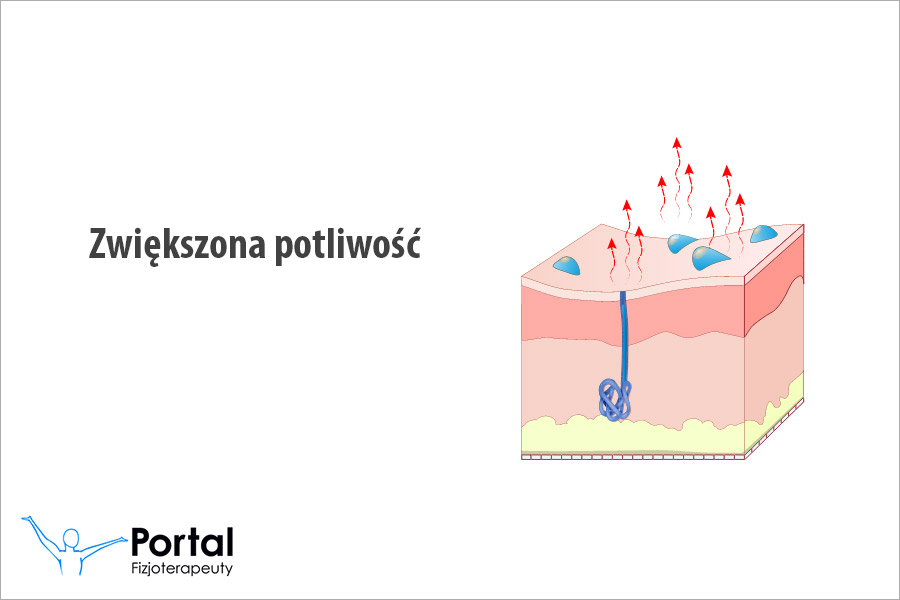 Zwiększona potliwość