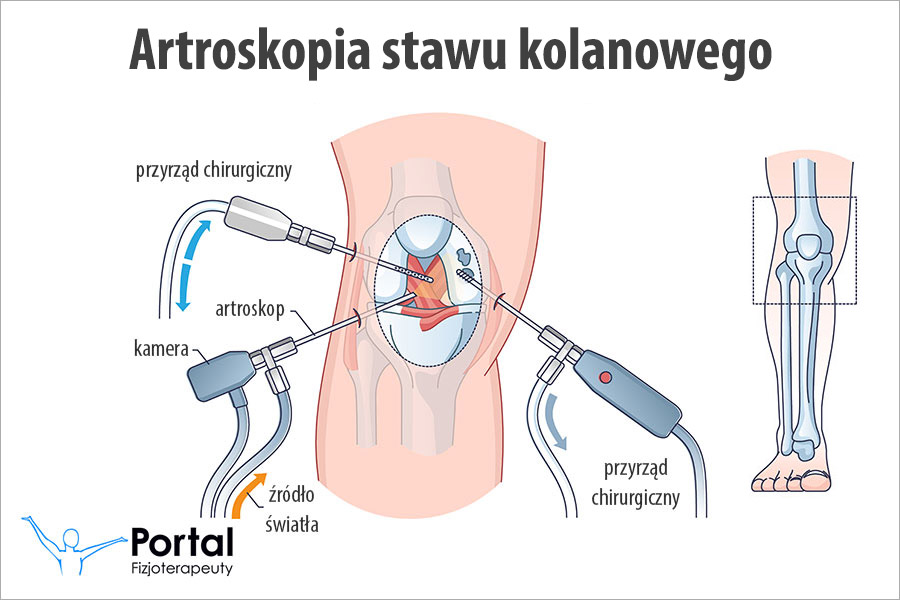 Artroskopia stawu kolanowego