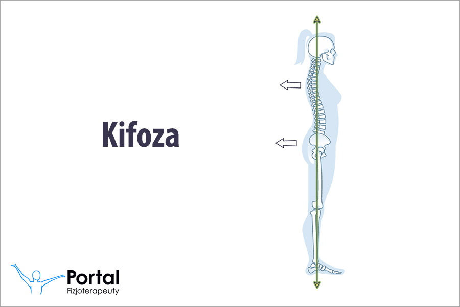 Kifoza