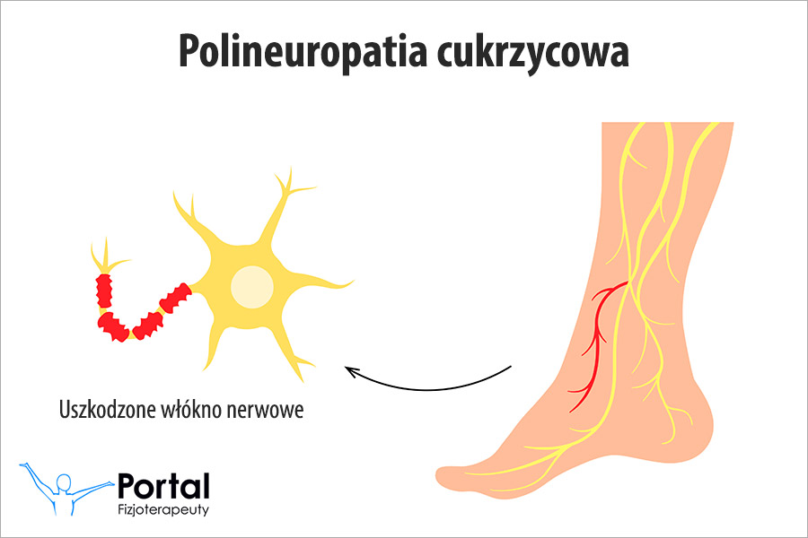 Polineuropatia cukrzycowa