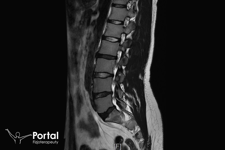 Przeciążenie kręgosłupa