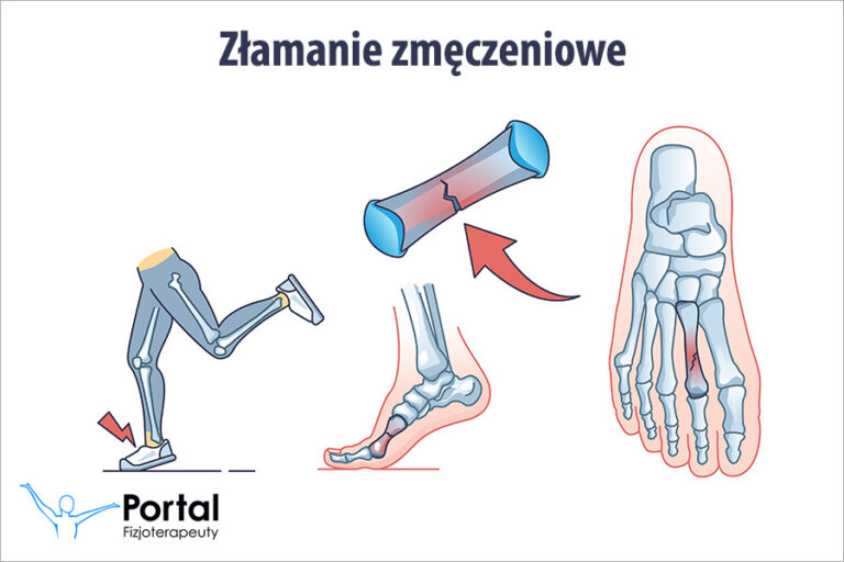 Złamanie zmęczeniowe