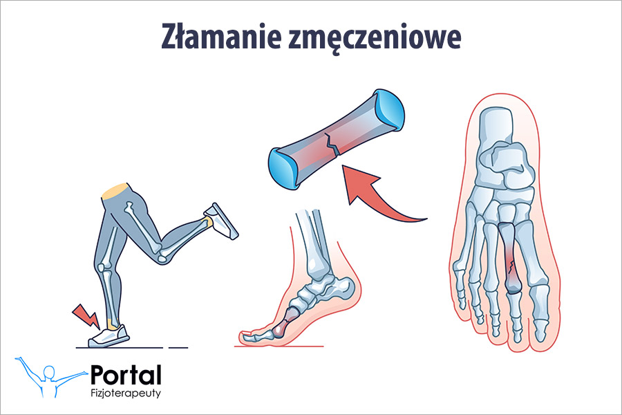 Złamanie zmęczeniowe