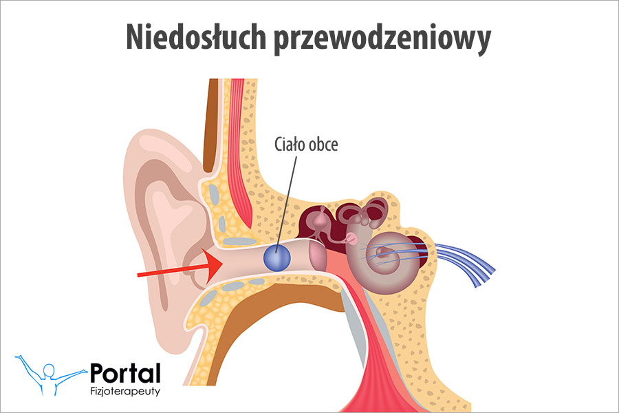Niedosłuch przewodzeniowy