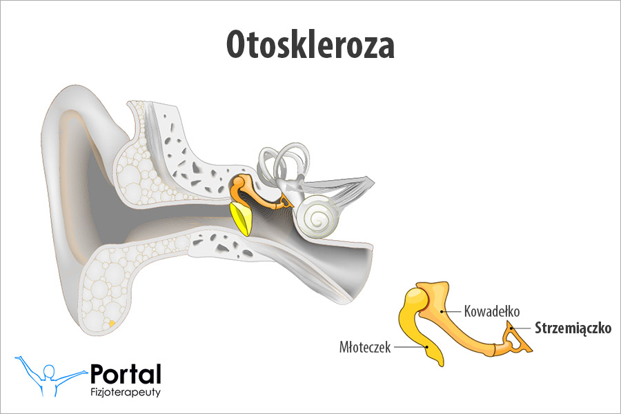 Otoskleroza