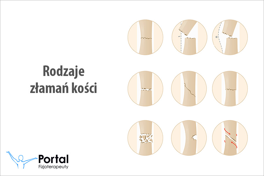 Rodzaje złamań kości