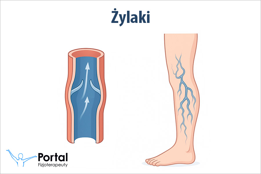 Żylaki