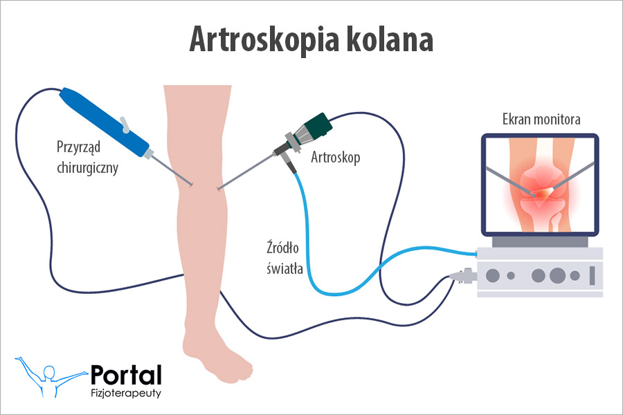 Artroskopia kolana