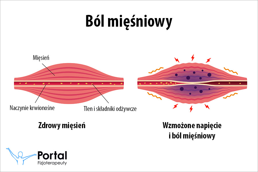 Ból mięśniowy
