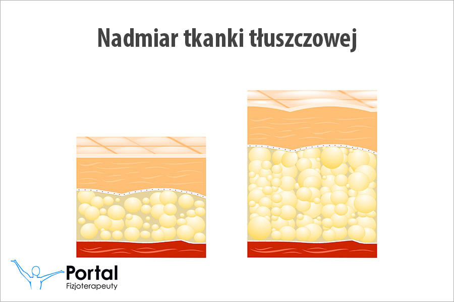 Nadmiar tkanki tłuszczowej