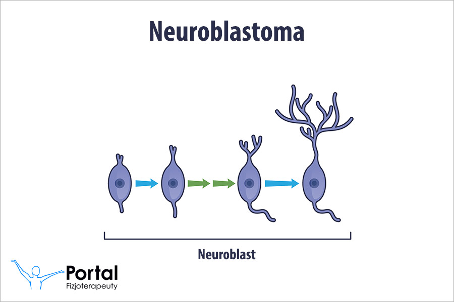 Neuroblastoma
