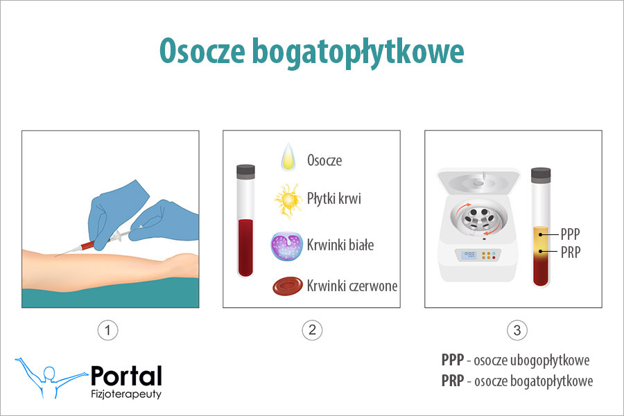 Osocze bogatopłytkowe