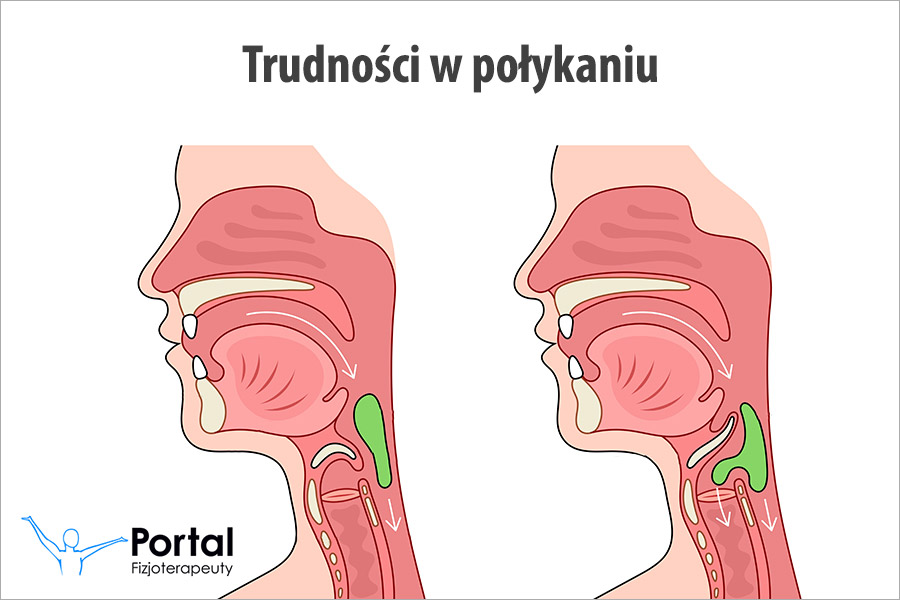 Trudności w połykaniu Trudności w połykaniu