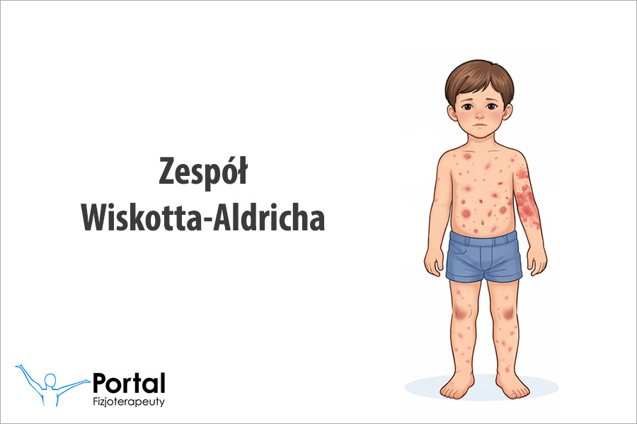 Zespół Wiskotta-Aldricha