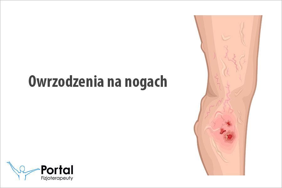 Owrzodzenia na nogach