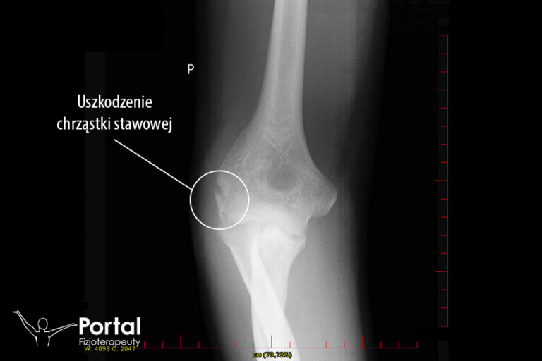 Uszkodzenie chrząstki stawowej
