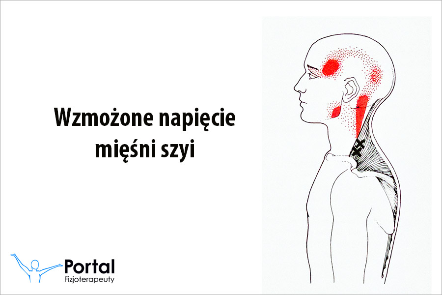 Wzmożone napięcie mięśni szyi