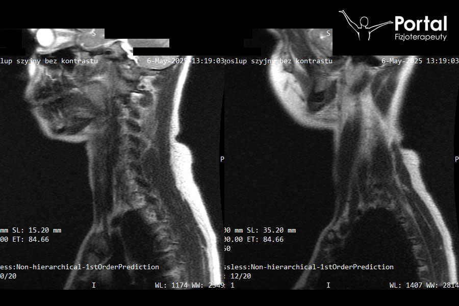 Zmniejszona lordoza szyjna