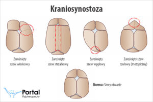 Kraniosynostoza