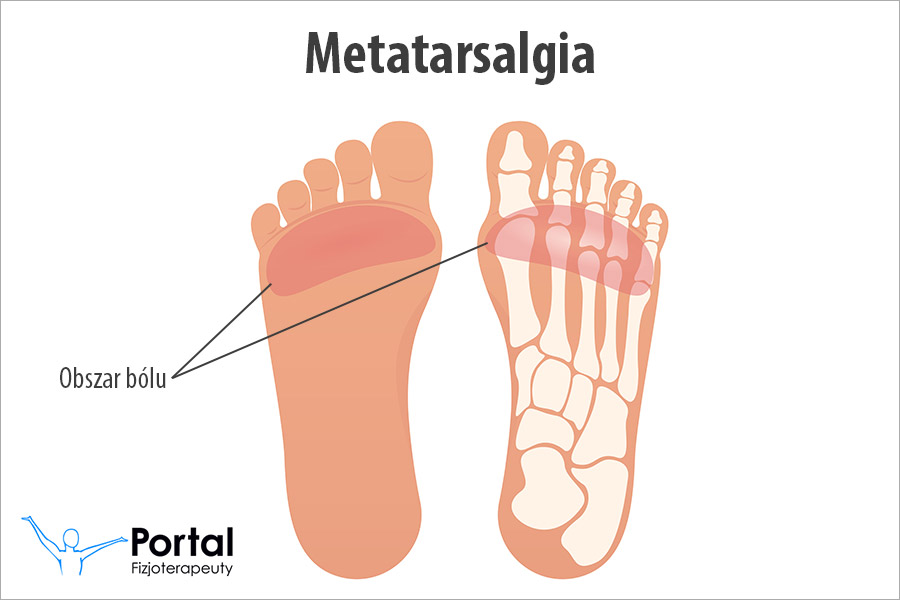 Metatarsalgia