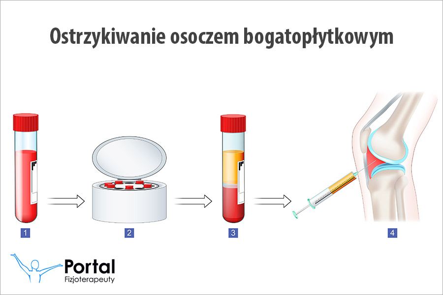Ostrzykiwanie osoczem bogatopłytkowym