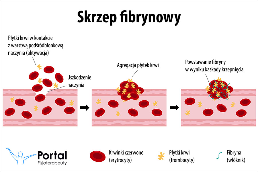 Skrzep fibrynowy