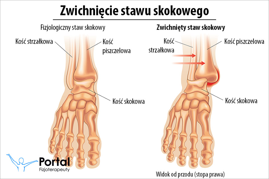 Zwichnięcie stawu skokowego