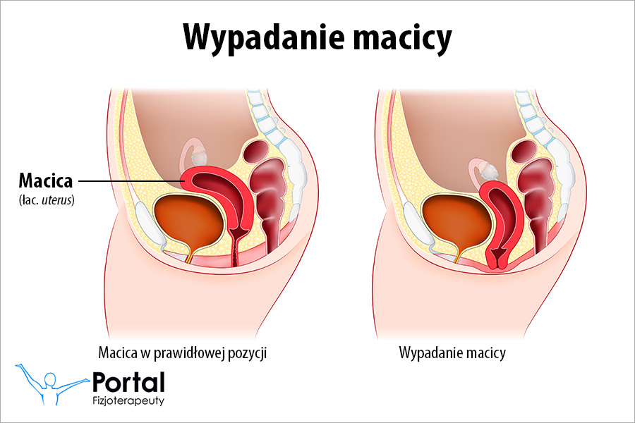 Wypadanie macicy