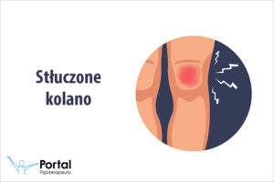 Stłuczone kolano