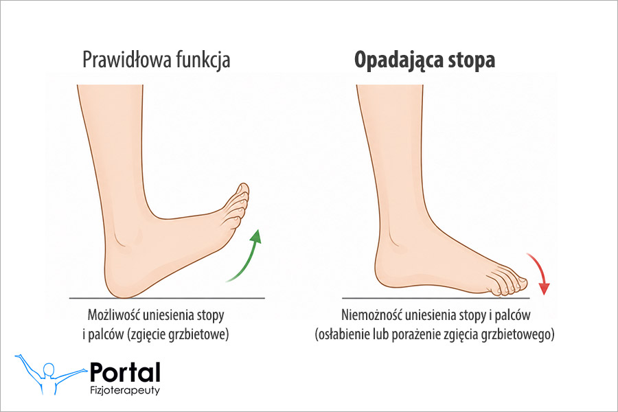 Opadająca stopa