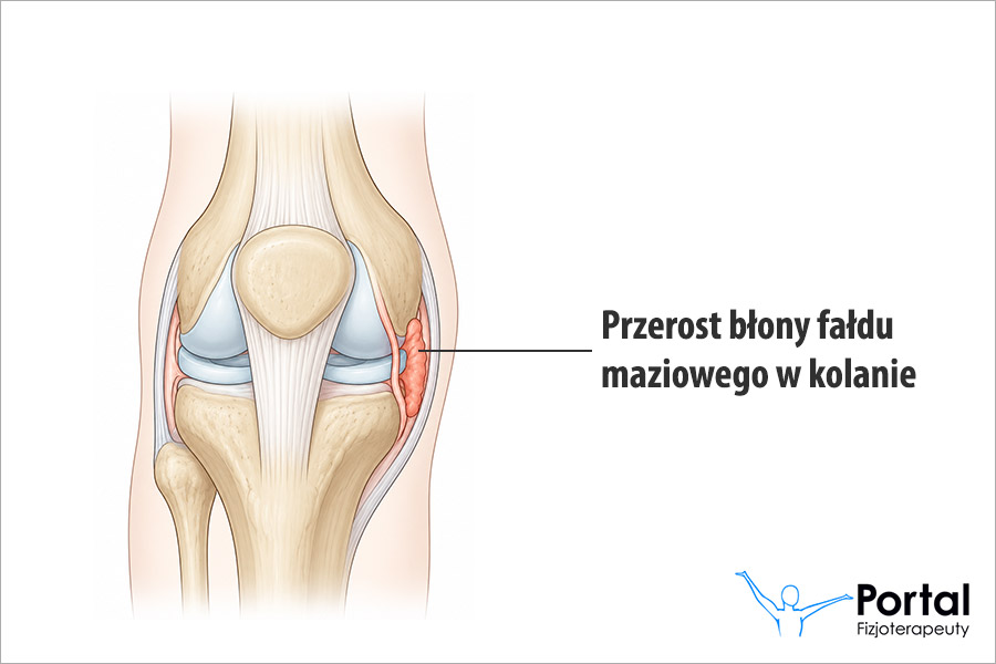 Przerost błony fałdu maziowego w kolanie