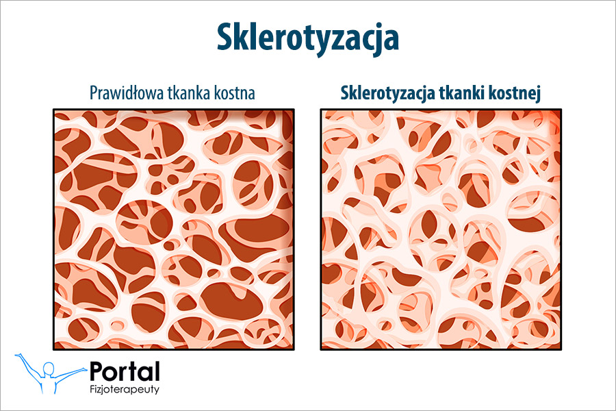 Sklerotyzacja