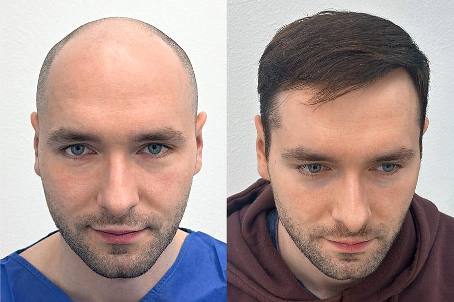 Przeszczep włosów za granicą czy w Polsce? Dlaczego opieka po zabiegu ma znaczenie