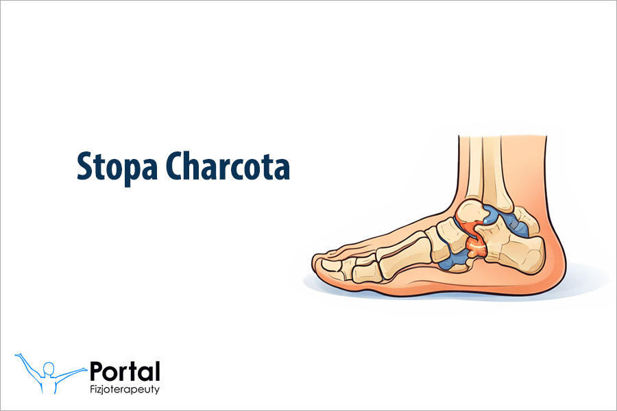 Stopa Charcota