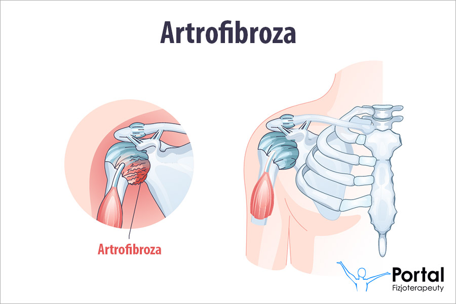 Artrofibroza