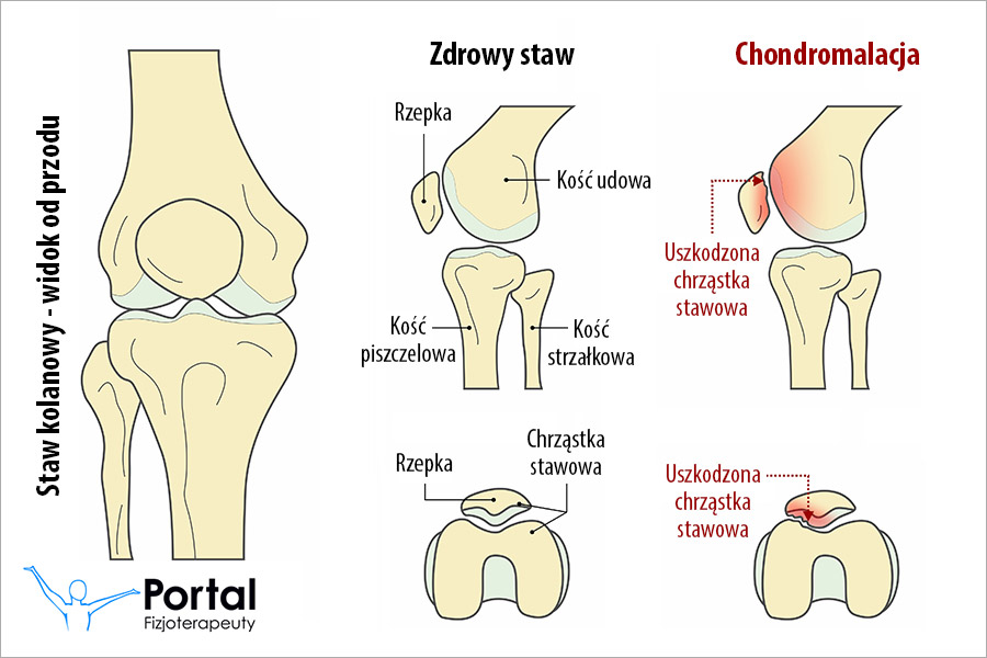 Chondromalacja