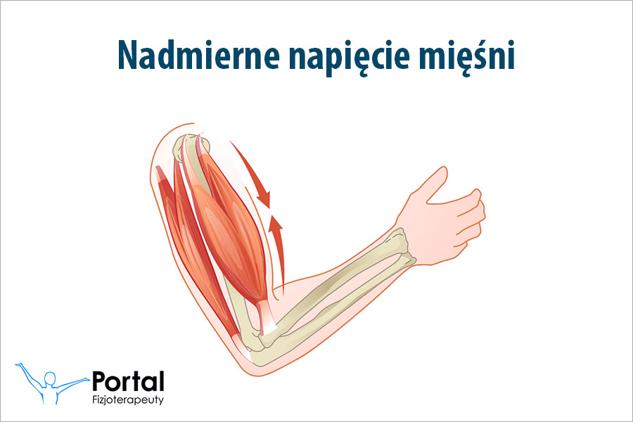 Nadmierne napięcie mięśni