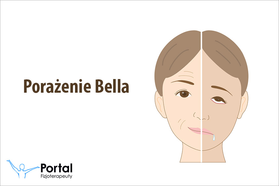 Porażenie Bella